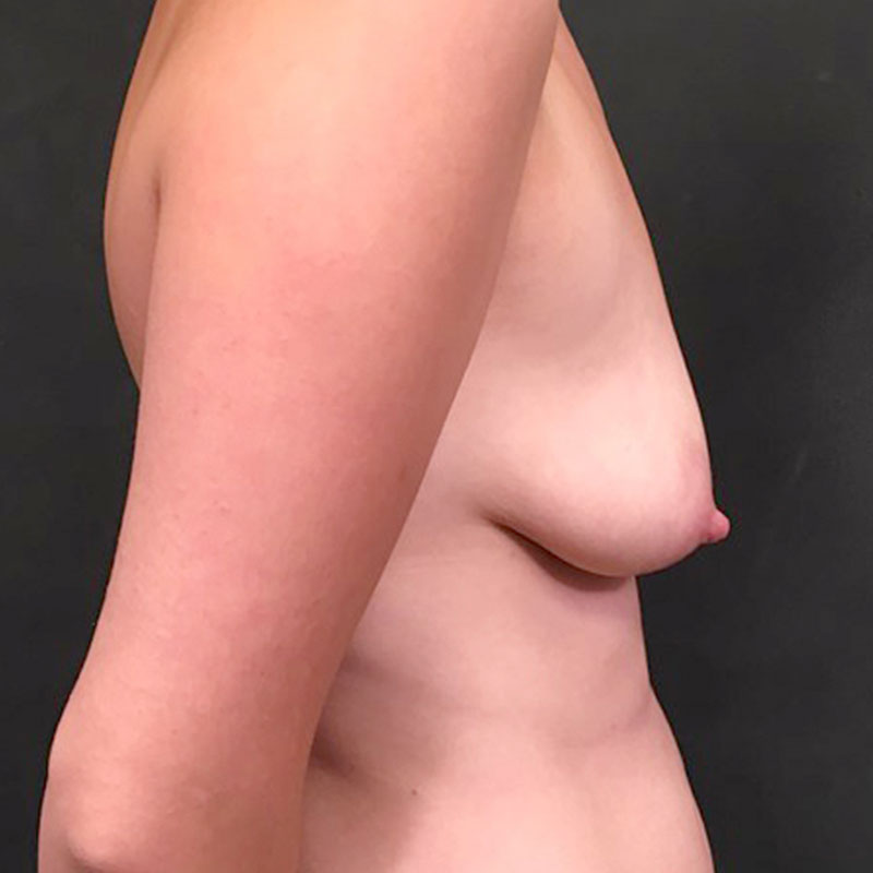 Breast Augmentation 09