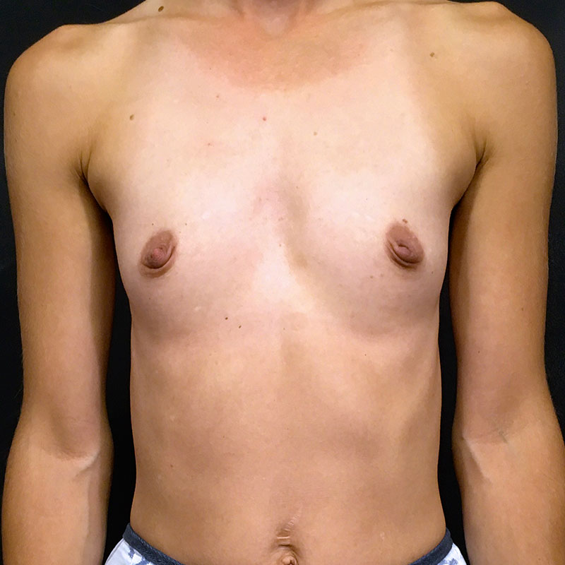 Breast Augmentation 01