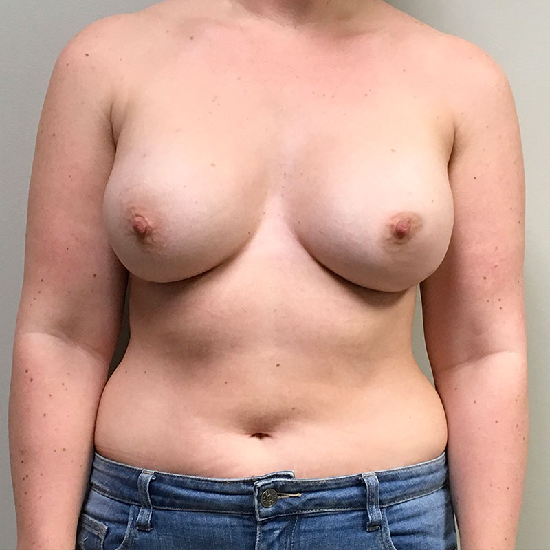 Breast Augmentation 64