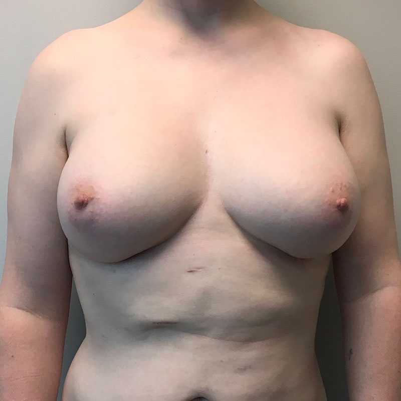 Breast Augmentation 69
