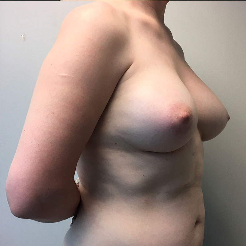 Breast Augmentation 05