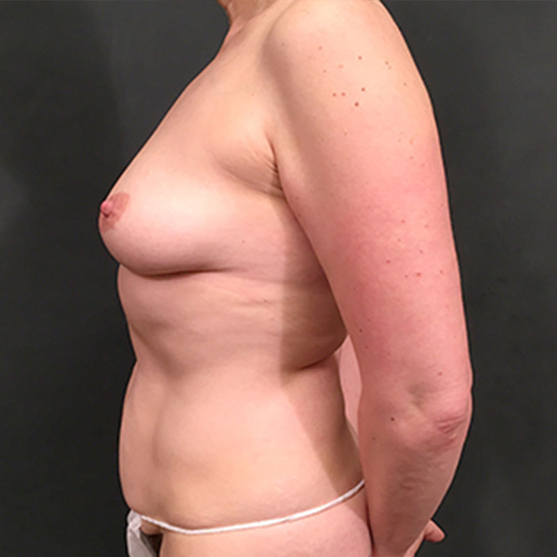 Breast Augmentation 03