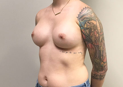 Breast Augmentation 03