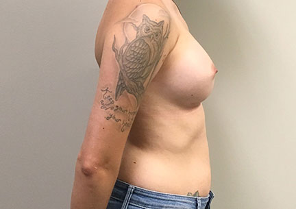 Breast Augmentation 09