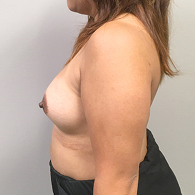 Breast Augmentation 05