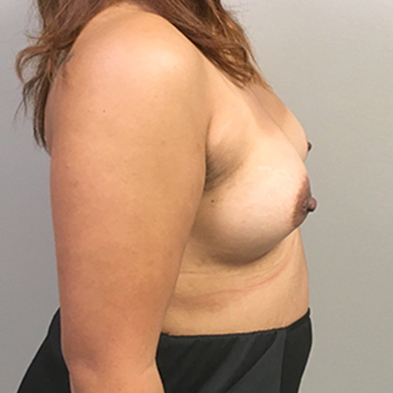 Breast Augmentation 09