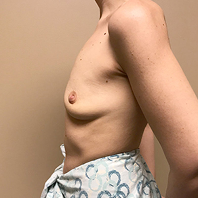 Breast Augmentation 05