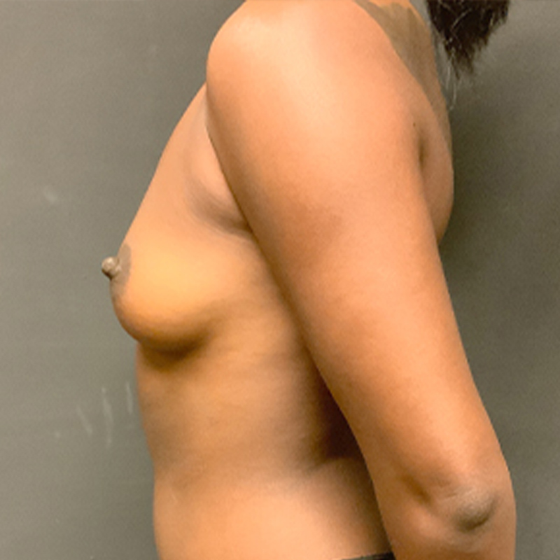 Breast Augmentation 05