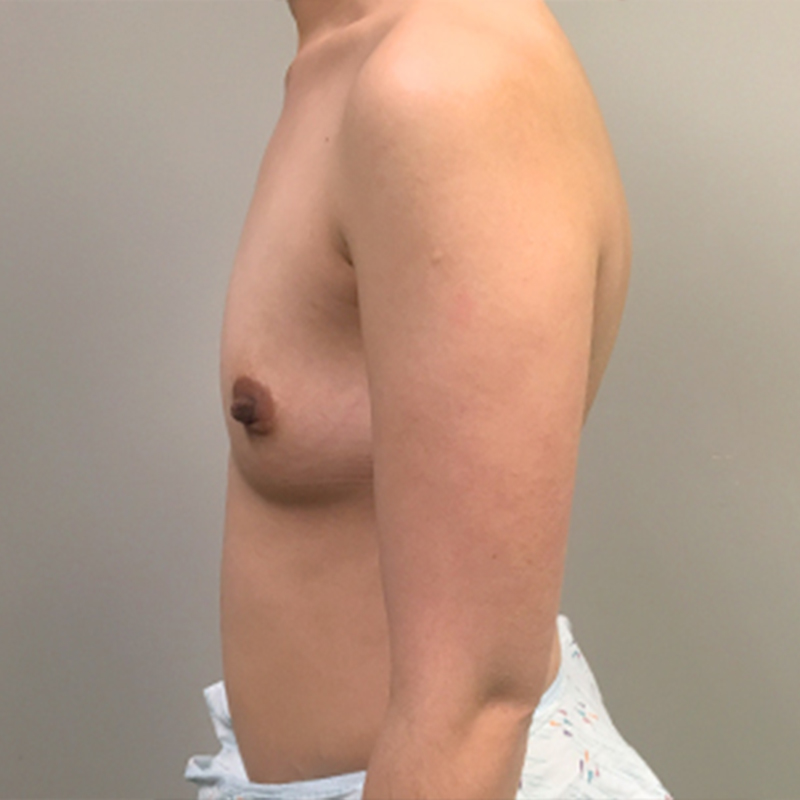 Breast Augmentation 05