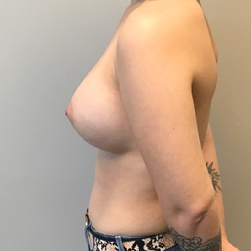 Breast Augmentation 03