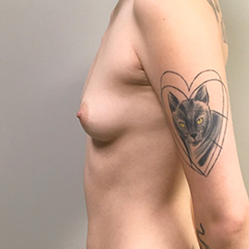 Breast Augmentation 05