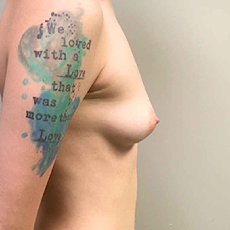 Breast Augmentation 09