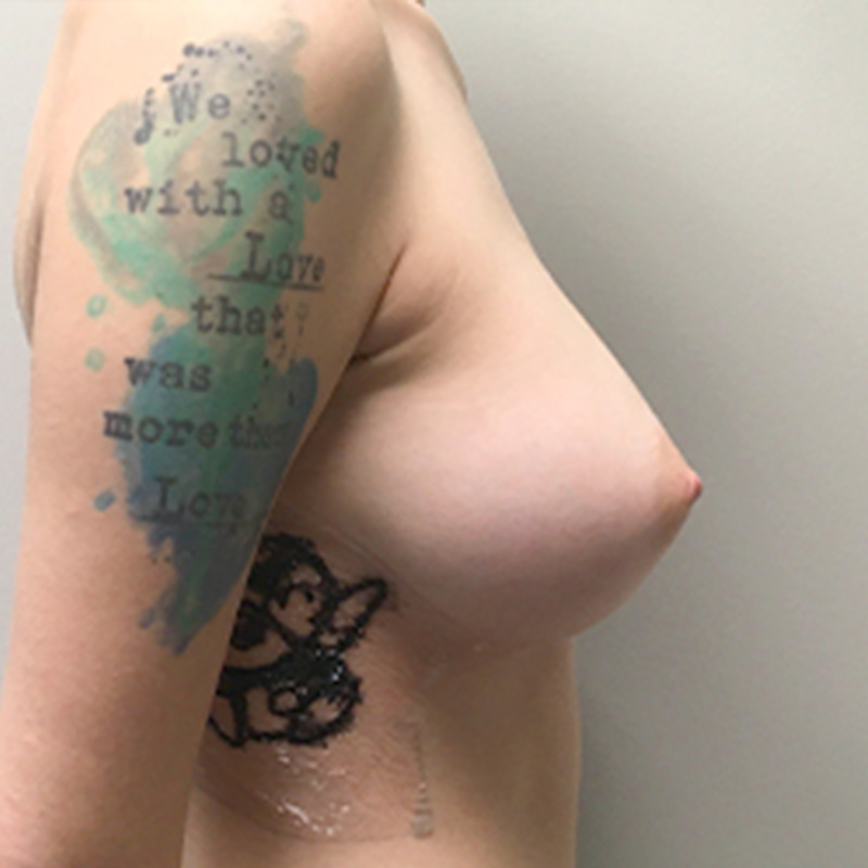 Breast Augmentation 09