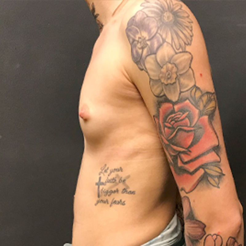 Breast Augmentation 05