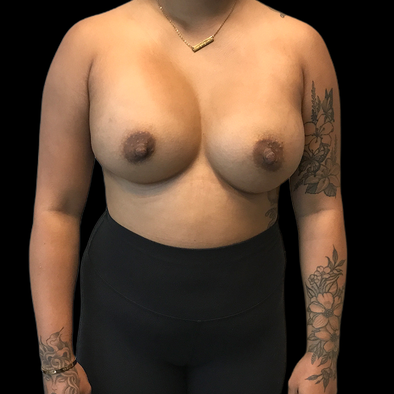 Breast Implant Exchange 01