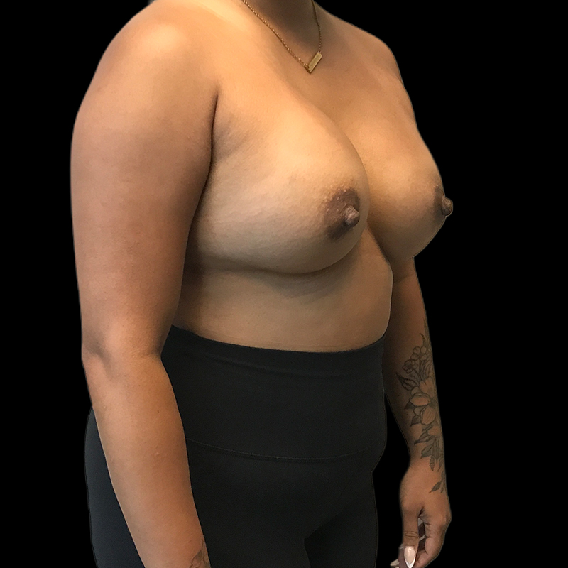 Breast Implant Exchange 03