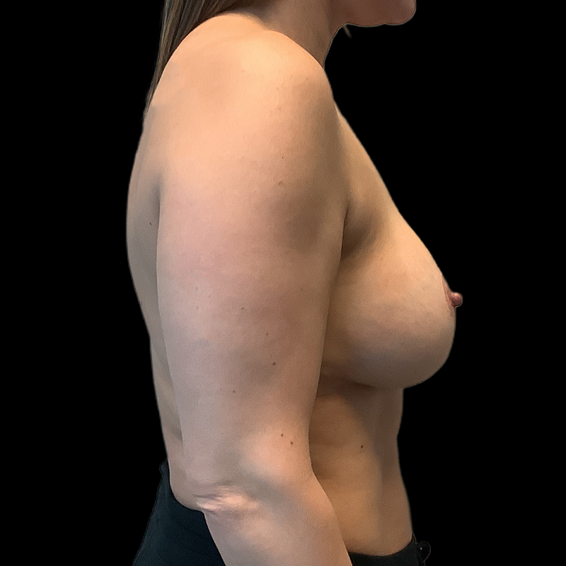 Breast Implant Exchange 03