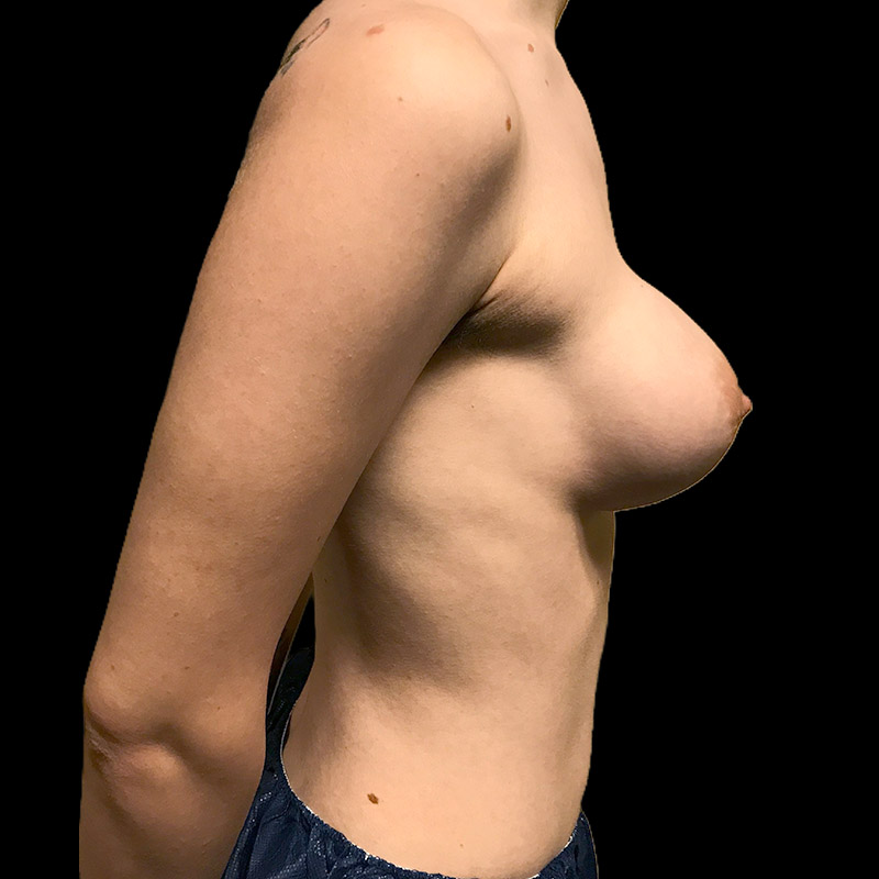 Breast Implant Exchange 05