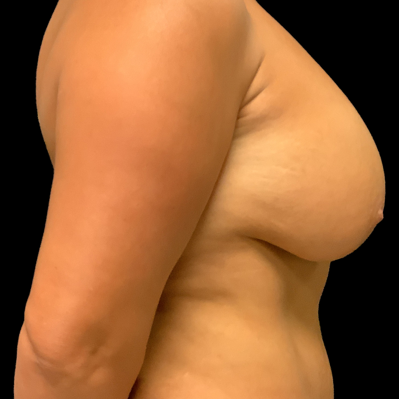 Breast Lift With Reduction 03
