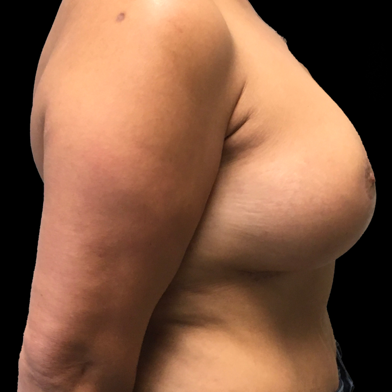 Breast Lift With Reduction 03