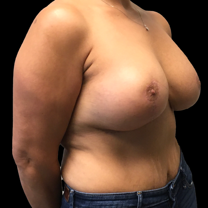 Breast Lift With Reduction 05
