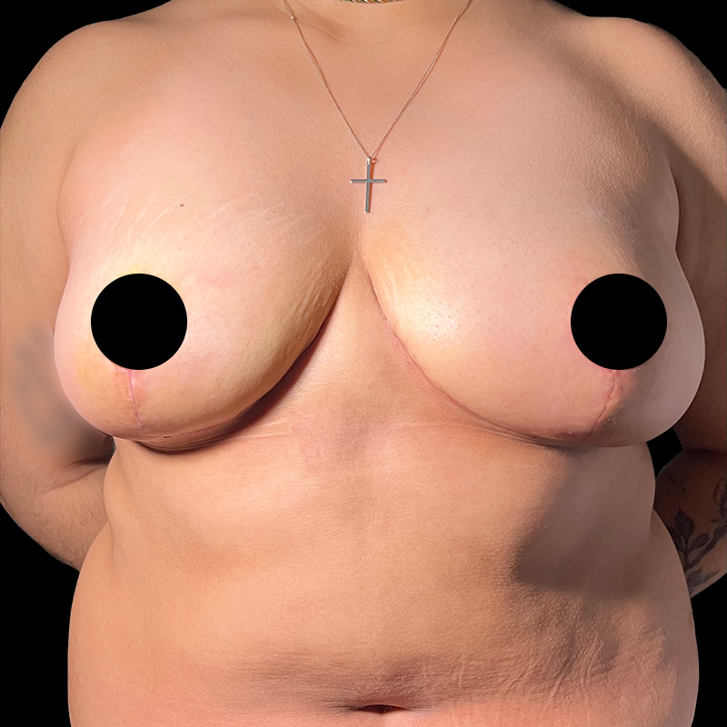 Breast Lift With Reduction 01