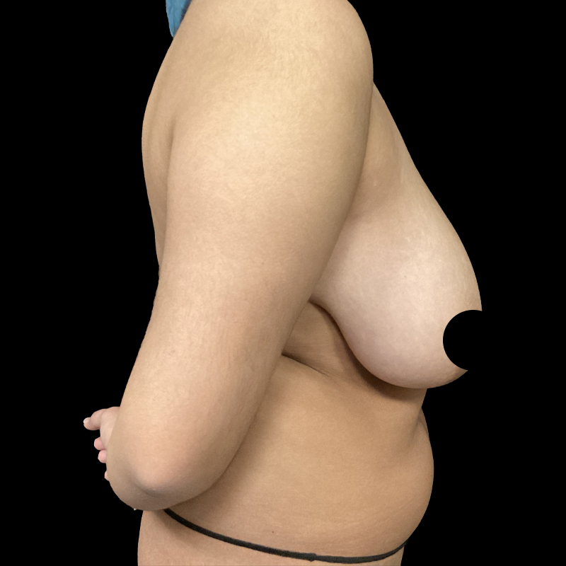Breast Lift With Reduction 03