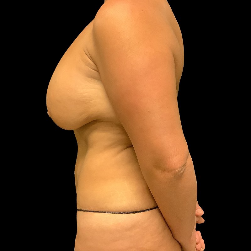 Breast Lift With Reduction 05