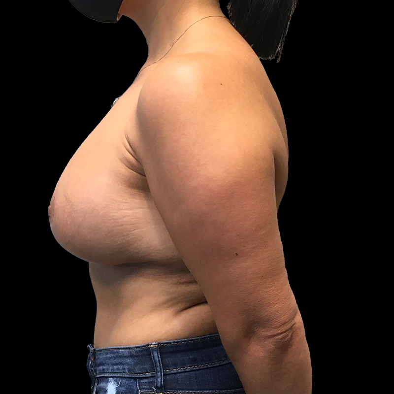 Breast Lift With Reduction 05