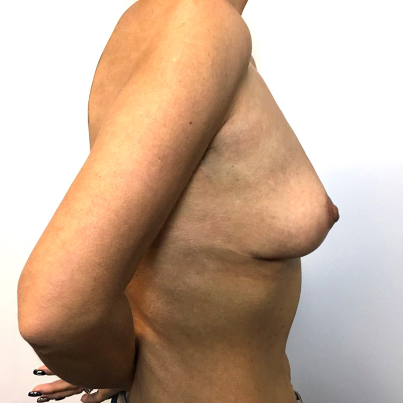 Breast Lift 07
