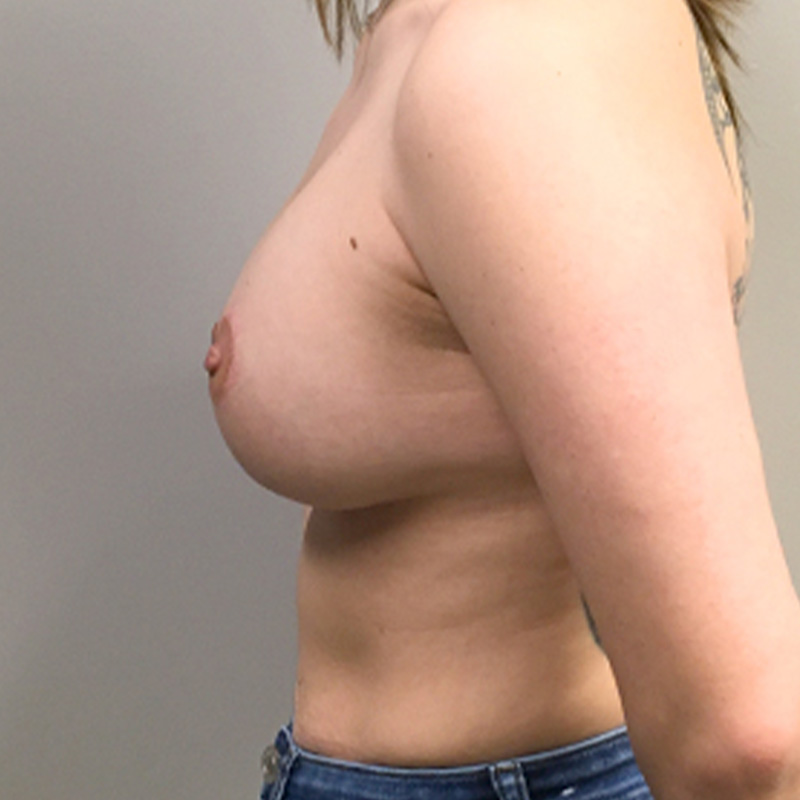Breast Lift 03