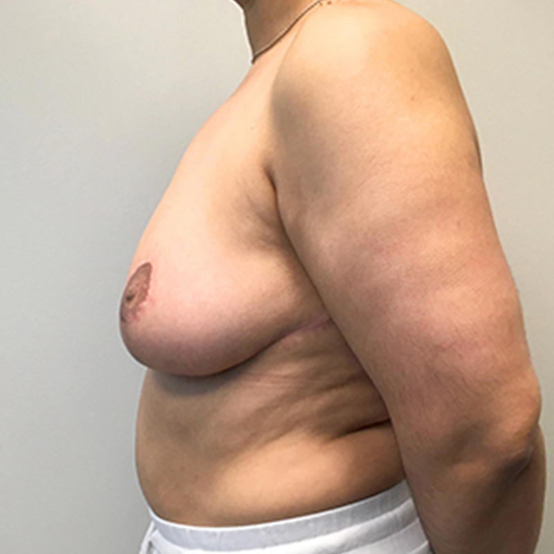 Breast Reduction 05