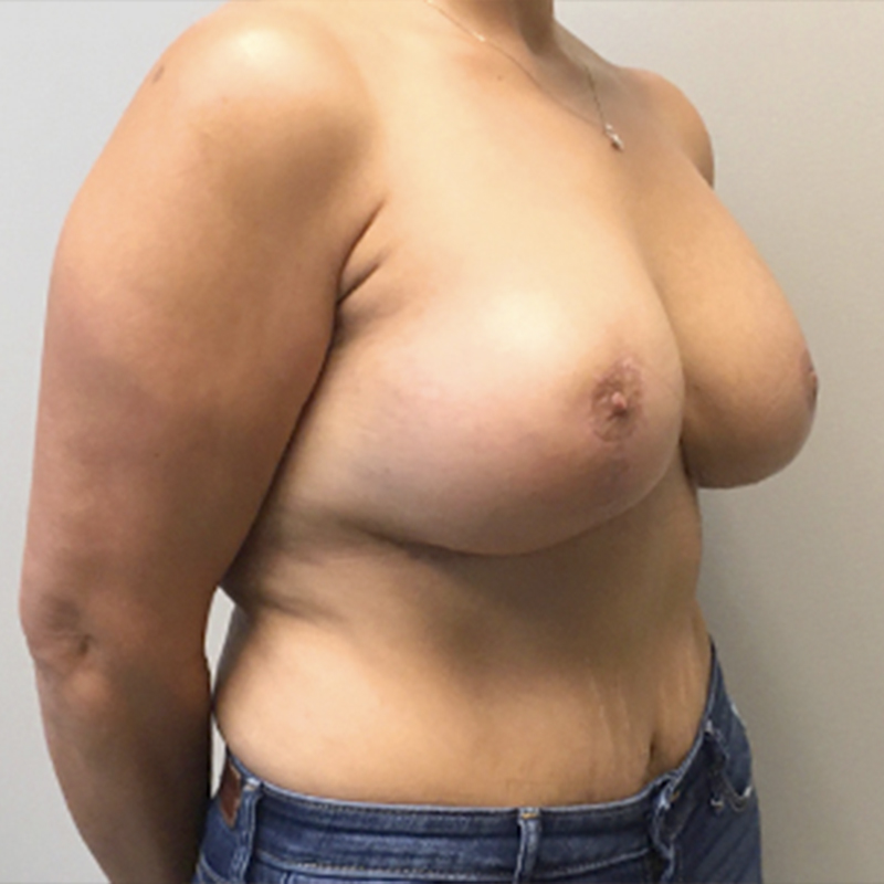 Breast Reduction 07