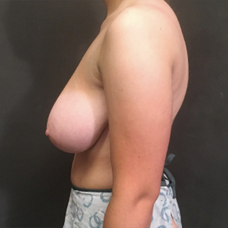 Breast Reduction 05