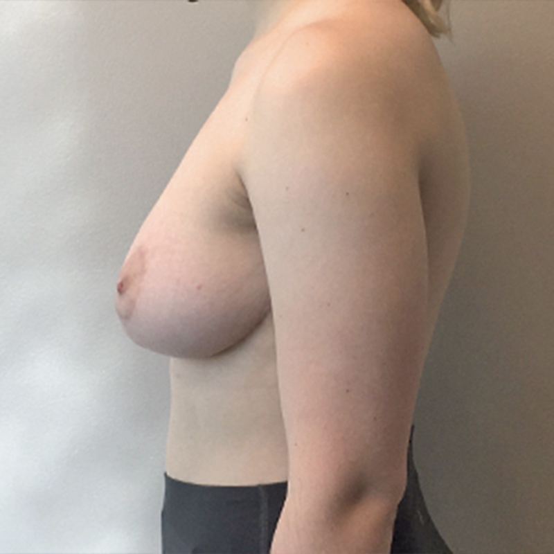 Breast Reduction 05