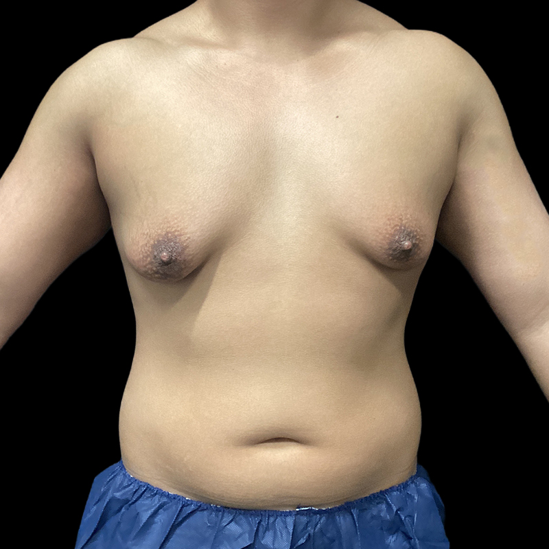 Chest Reconstruction With Free Nipple Grafts 01