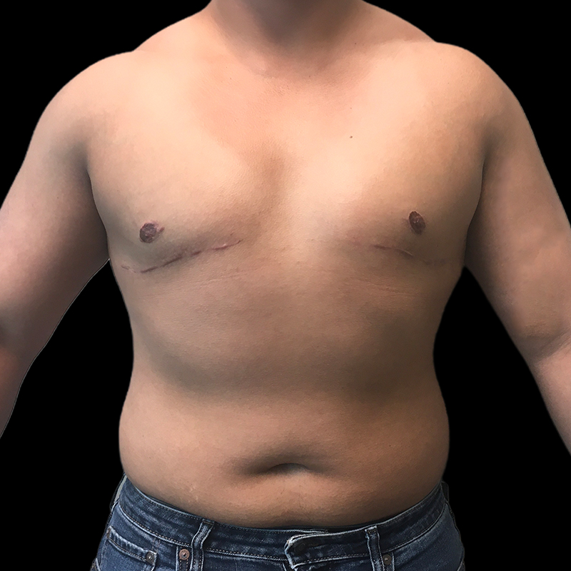 Chest Reconstruction With Free Nipple Grafts 01