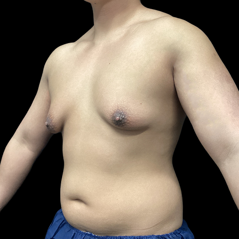 Chest Reconstruction With Free Nipple Grafts 03