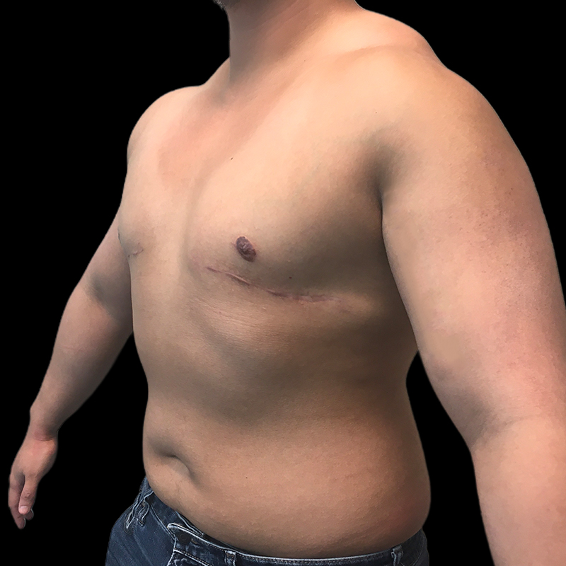 Chest Reconstruction With Free Nipple Grafts 03