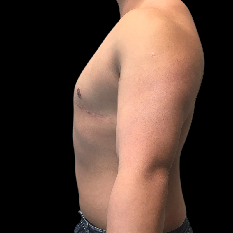 Chest Reconstruction With Free Nipple Grafts 05