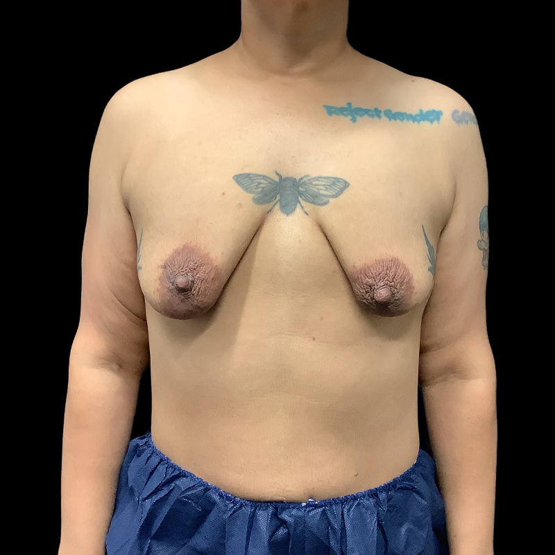 Chest Reconstruction With Free Nipple Grafts 01