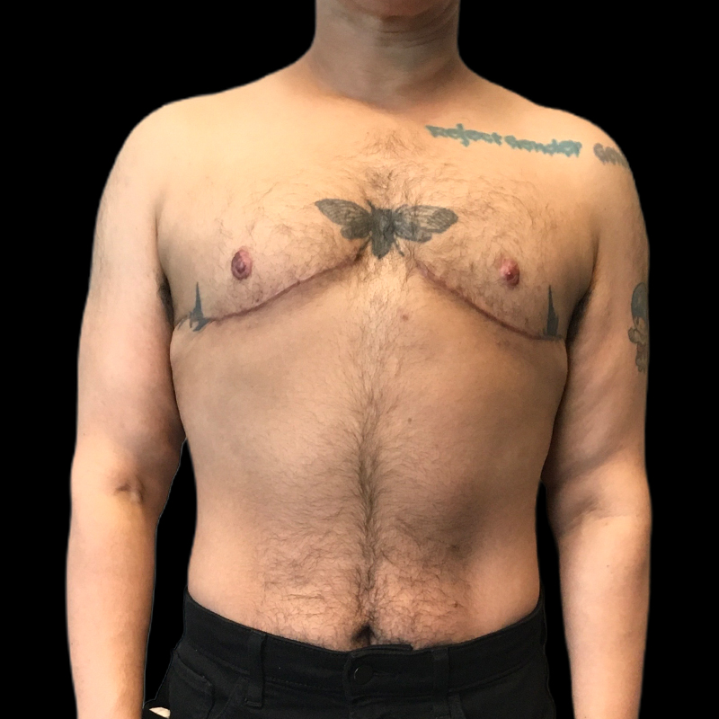 Chest Reconstruction With Free Nipple Grafts 02