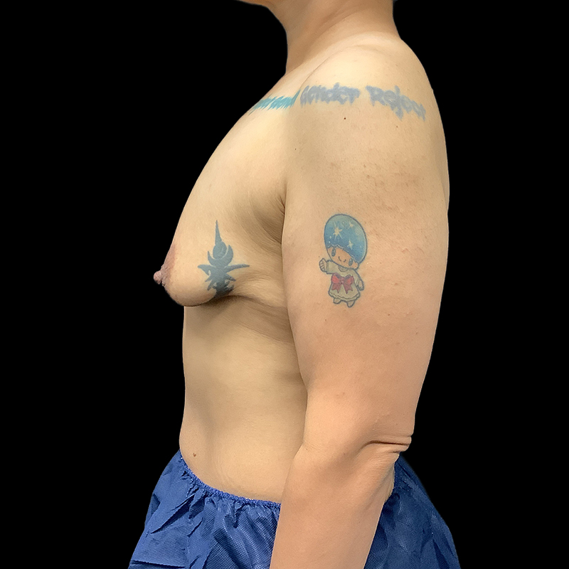 Chest Reconstruction With Free Nipple Grafts 05