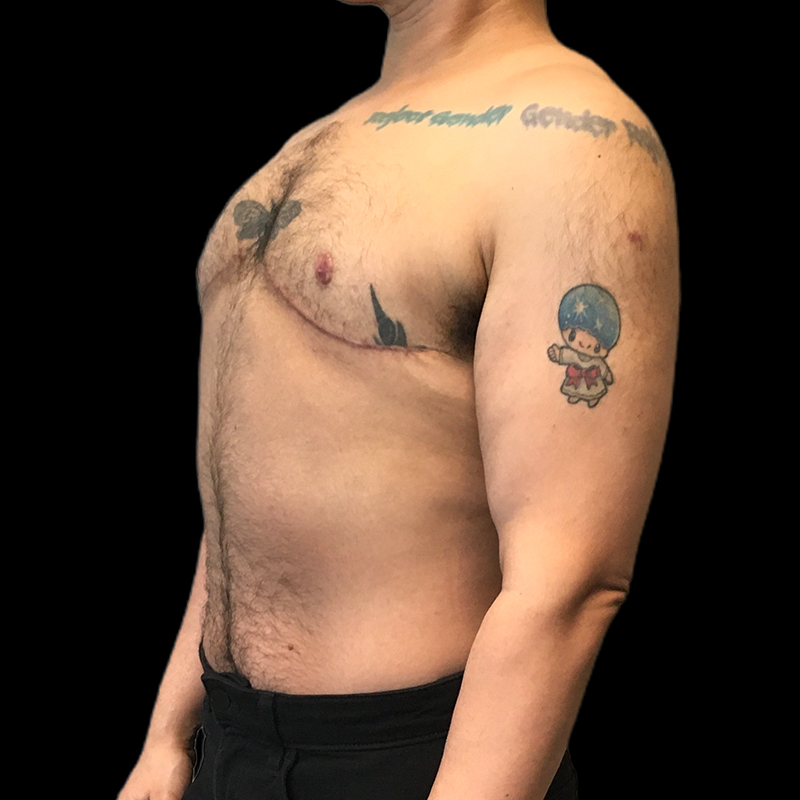 Chest Reconstruction With Free Nipple Grafts 05