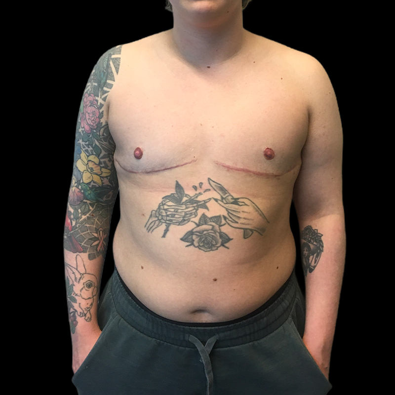 Chest Reconstruction With Free Nipple Grafts 01