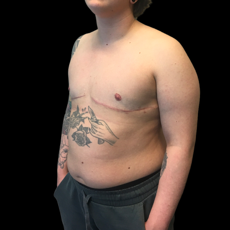 Chest Reconstruction With Free Nipple Grafts 03