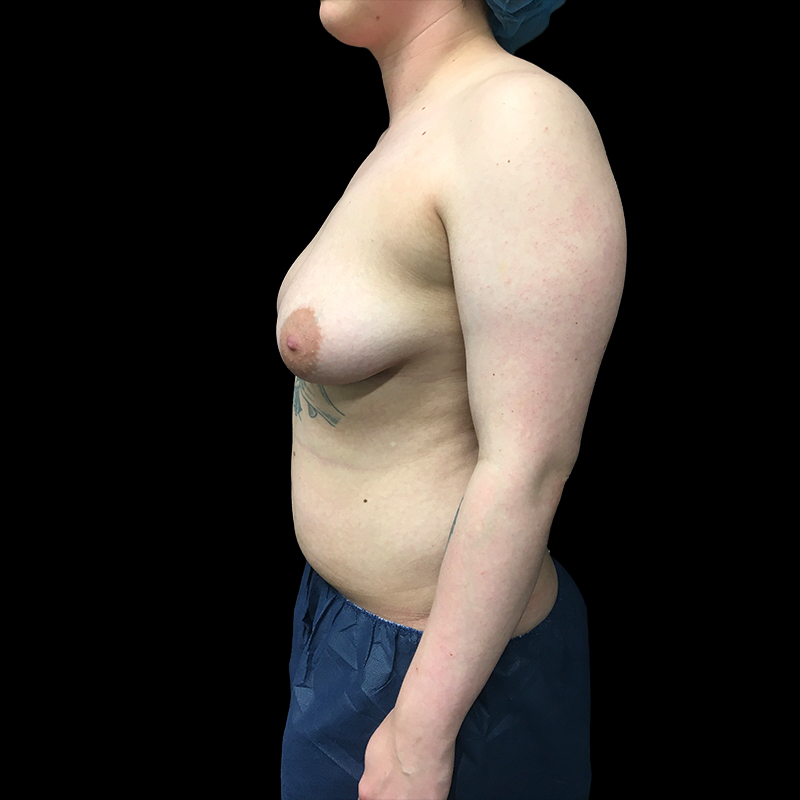 Chest Reconstruction With Free Nipple Grafts 05