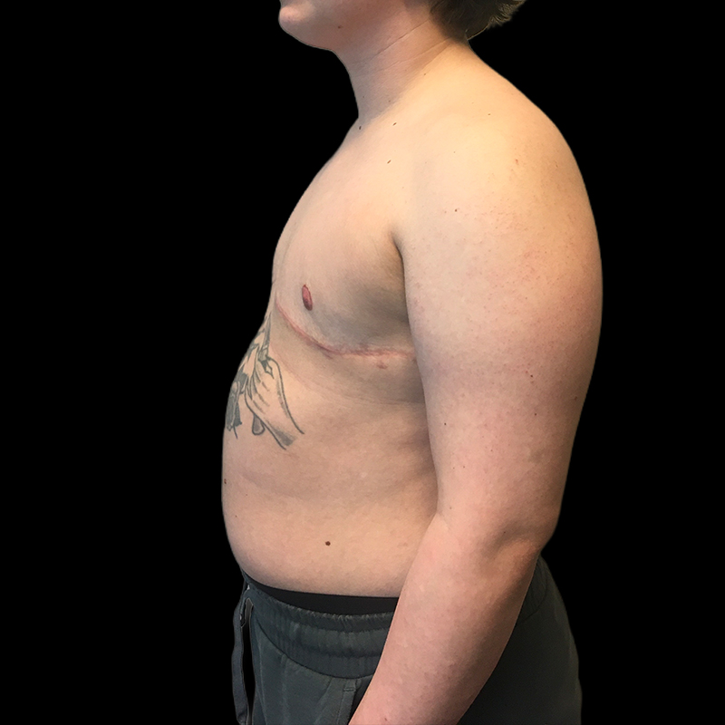 Chest Reconstruction With Free Nipple Grafts 05