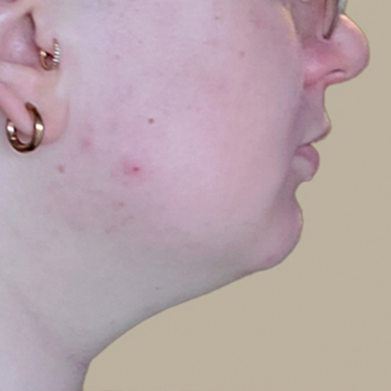 Chin Implant 05