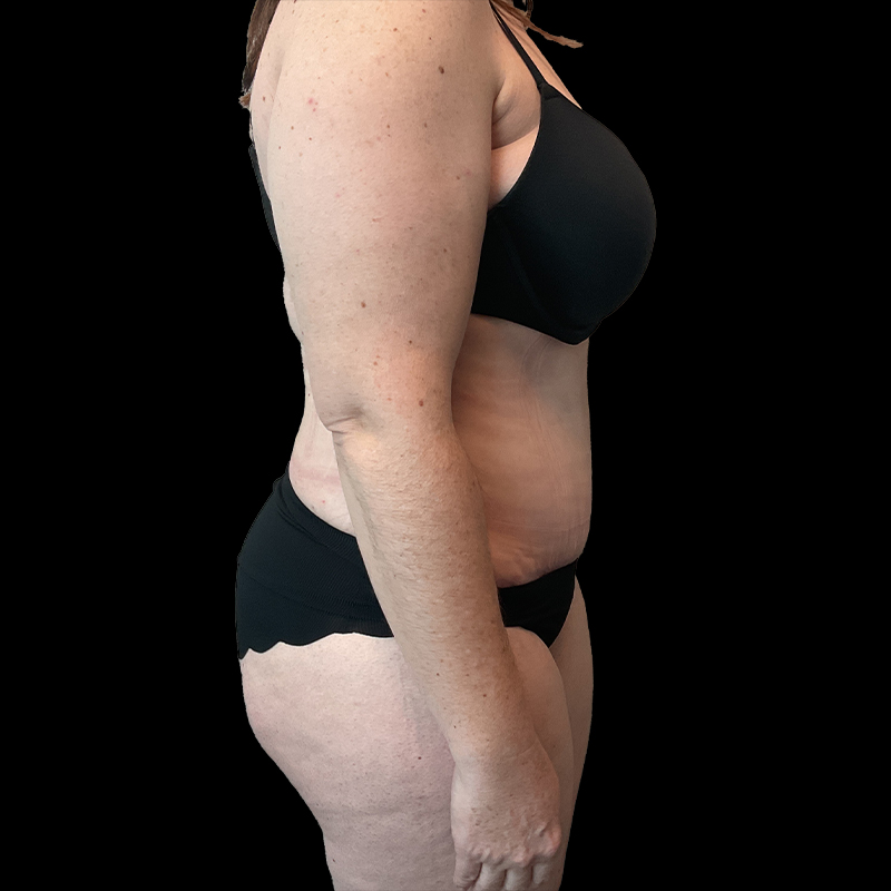 Extended Abdominoplasty 03